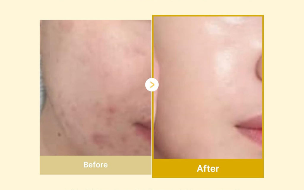 Kojic Acid Turmeric Overnight Peel Off Mask – Korean Skincare for Clearer, Radiant Skin - ElevateHealthTech