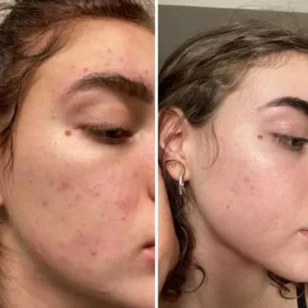 Turmeric Kojic Acid Cleansing Pads - ElevateHealthTech