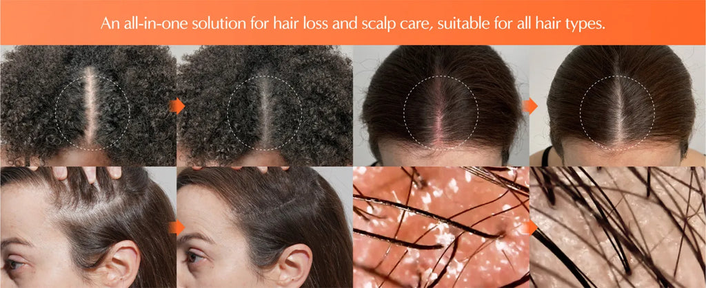Hair Growth Serum with Massage Brush Head – Scalp Nourishing & Follicle Care Treatment (100ml) - ElevateHealthTech